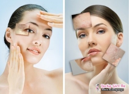 Face comentarii cu laser resurfacing (măcinare) resurfacing laser de comentarii față