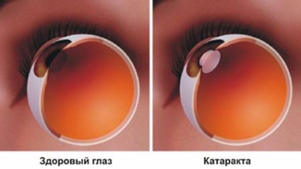 Tratamentul cataractei remedii populare mai mult de 10 dintre cele mai bune rețete (mai mult) Tratamentul cataractei remedii populare mai mult de 10 din cele mai bune rețete