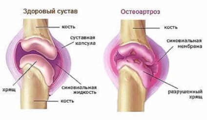 Tratamentul articulației genunchiului, în cazul în care dureri genunchi si alte articulatii ale picioarelor