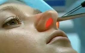 Heal boli (amigdalite LOR, rinite, sinuzite) cu laser (laser) Heal boli (amigdalite LOR, rinite, sinuzite) cu laser