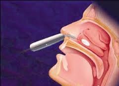 Heal boli (amigdalite LOR, rinite, sinuzite) cu laser (amigdalite) Heal boli (amigdalite LOR, rinite, sinuzite) cu laser