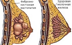 Tratamentul mastitei modul în care aceasta ar trebui să fie efectuată (mastita) Tratamentul mastitei modul în care aceasta ar trebui să fie efectuată