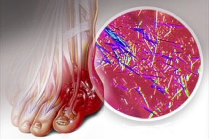 medicamente tratament Gout, deducând acid uric (acid uric in sange) medicamente tratament gutei, deducând acidului uric