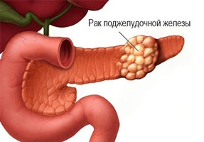 Tratamentul cancerului pancreatic - chimioterapie, durere (cancer) Tratamentul cancerului pancreatic - chimioterapie, durere