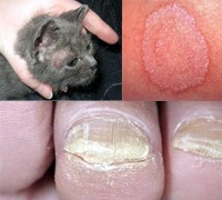 Tratamentul pecingine (impetigo) Tratamentul pecingine