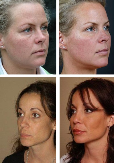 Lipofilling comentarii față, lecturi și perioada de reabilitare, fotografii, preturi (lipofilling) Lipofilling comentarii față, lecturi și perioada de reabilitare, fotografii, preturi