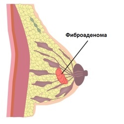 Simptome Frunza-san fibroadenom si tratament (san) Frunza-fibroadenom simptomelor mamare și a tratamentului
