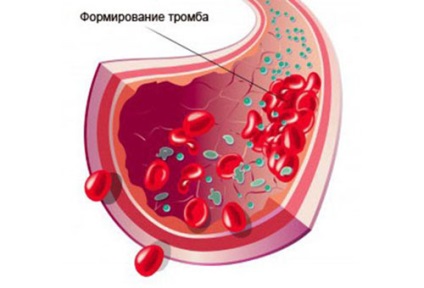 Hole după imagine extracție dentară ca vindecare (dinte) Hole după îndepărtarea fotografia dintelui, așa cum vindecă