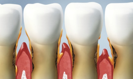 Marginal tratamentul periodontitei, cauze, simptome, diagnostic (periodontita) Tratamentul parodontitei Marginal, cauze, simptome, diagnostic