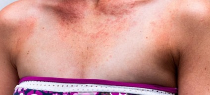 urticarie mecanică () urticarie mecanică