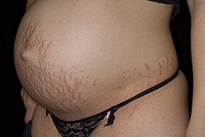 Cauzele mecanice urticarie și tratament (tratament) Cauzele urticarie mecanice și tratament