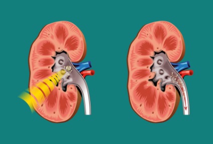 Urolitiaza în simptomele și tratamentul bărbați (simptome pietre la rinichi in diagnostic barbati semne de prevenire a tratamentului) Urolitiază la bărbați simptome și tratament