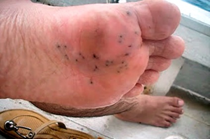 Stepped pe un arici de mare (în trepte) Am călcat pe un arici de mare