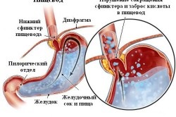 Lipsa tratamentului cardia gastric (cardia) Lipsa tratamentului cardia gastric