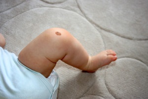 Este periculos pentru nou-născuți nevilor (nevilor) Do birthmarks sunt periculoase la nou-nascuti