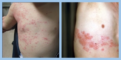 Herpesul zoster este un herpes, un virus herpes (spre deosebire de zona zoster herpes zoster) Herpesul zoster este un herpes, virusul herpes