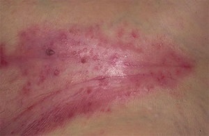 erupții cutanate Scutec în inghinală la bărbați și femei, cum să trateze, provocând erupții cutanate scutec apare la adulți, moduri (bărbați) erupții cutanate Scutec în inghinală la bărbați și femei, cum să trateze, provocând erupții cutanate scutec apare la adulți, metode