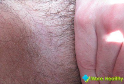 Chafing între picioare (scutec erupții cutanate) Chafing între picioare