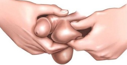 testis omitere (criptorhidie diagnostic recuperat) Omiterea unui testicul