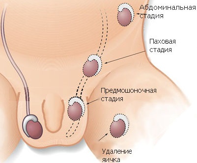 testis omitere (criptorhidie diagnostic recuperat) Omiterea unui testicul