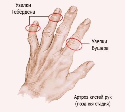 Osteoartrita mâinilor (osteoartrita) Osteoartrita a mâinilor