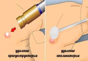 Papiloma ureche dacă frica, diagnostic și tratament (tratament) Papiloma ureche dacă frica, diagnostic și tratament