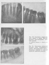 Periodontita (parodontite marginale), stomatologie preventivă (boala parodontala) Periodontita (parodontite marginale), stomatologie preventivă