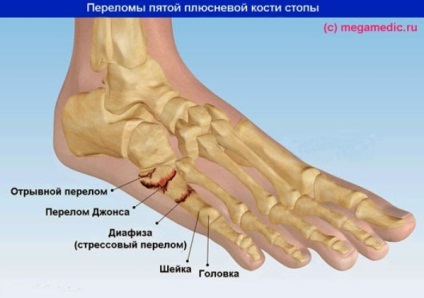 Fractura oasele metatarsiene ale piciorului (picioare) Fractura oasele metatarsiene ale piciorului