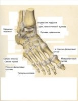 articulatiei metatarsofalangiene a piciorului - artroza, tratamentul