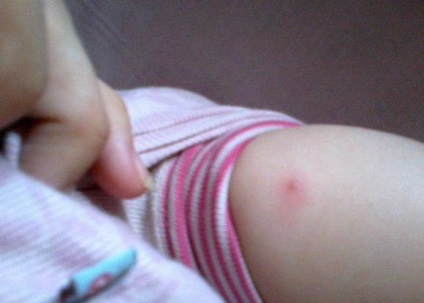 vaccinarea DTP înroși loc atunci când găzdui roseata de pe piele după vaccinare DPT și publice (după) vaccinarea DTP clătit loc atunci când roseata pe piele după vaccinarea cu DTP și va avea loc în public