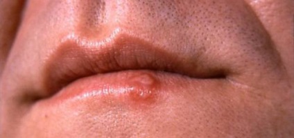 Înroșire și colțurile descuamarea buzelor sunt eliminate într-o clipită! (Exfoliere) Înroșire și colțurile descuamarea buzelor sunt eliminate într-o clipită!