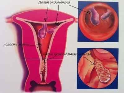 Polip în simptomele uterului (polip) Polip în simptomele uterului