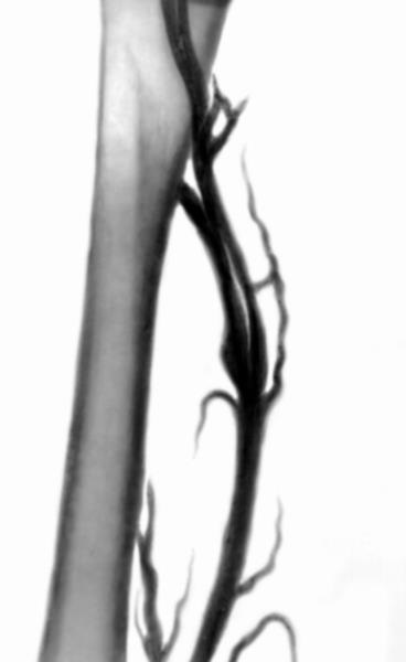 Sindromul Posttromboflebitny - o (consiliere de specialitate clarificare) Sindromul Posttromboflebitny - o