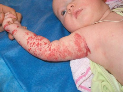 Cauzele birthmarks la nou-nascuti, la sugari rosii semne din nastere (nou-născuți) Cauzele birthmarks la nou-nascuti, la sugari rosii semne din nastere