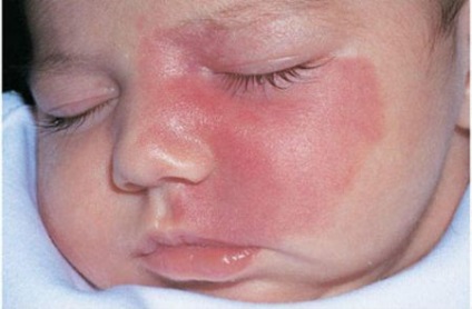 Cauzele birthmarks la nou-nascuti, semne din nastere roșii copii (roșu) Cauzele birthmarks la nou-nascuti, la sugari rosii semne din nastere