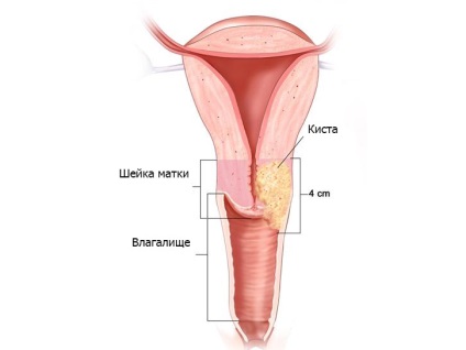 Cauzele chisturi pe colul uterin (apariție) Cauzele chisturi pe colul uterin