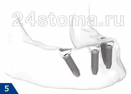 Protetic proteză implant de procedura (proteza) Protetica pe implante pentru procedura protetica