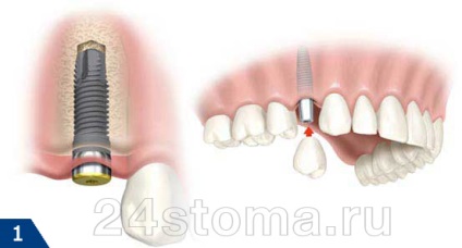 Protetic proteză implant de procedura (proteza) Protetica pe implante pentru procedura protetica