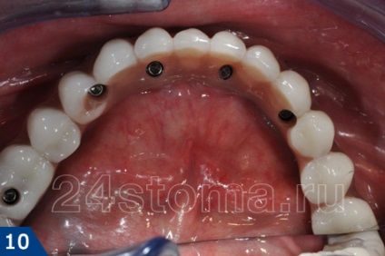 Protetic proteză implant de procedura (implant) Protetica pe implante pentru procedura protetica