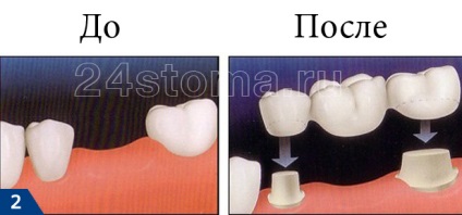 Protetic proteză implant de procedura (implant) Protetica pe implante pentru procedura protetica