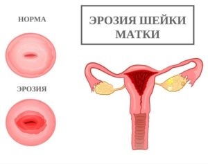 Contraindicații pentru eroziune de col uterin, care pot și nu pot face (eroziune) Contraindicații pentru eroziune de col uterin, care pot și nu pot face
