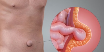 hernie ombilicala la un copil sau adult - de ce există un tratament chirurgical și de prevenire (pentru adulți) hernie ombilicala la un copil sau adult - de ce există un tratament chirurgical și de prevenire