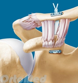 Spargerea simptomelor articulare acromioclavicular, tratament, chirurgie, ruptură acromiala ligament (acromioclavicular) Spargerea simptomelor articulare acromioclavicular, tratament, chirurgie, ligament acromiala ruptura