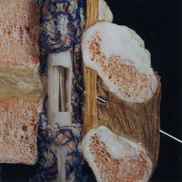 anestezie sacral epidurală (anestezie) Sacrale și anestezie epidurală