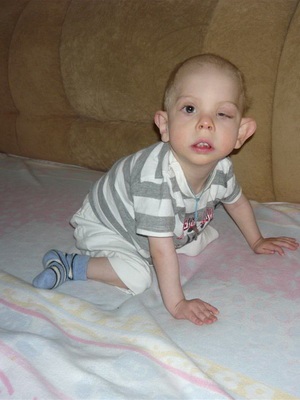 Sindromul Pierre Robin este o fotografie a copiilor, etiologia și tratamentul sindromului lui Pierre Robin