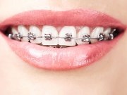 Aglomerarea de etiologie dinților, consecințele, metodele de eliminare (gradul de crowding dentare) Aglomerarea de etiologie dinților consecințelor, metodele de eliminare