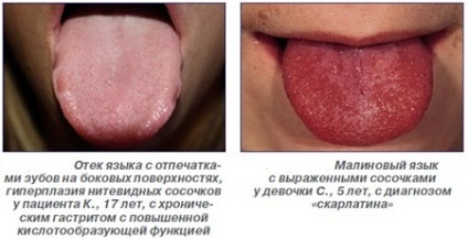 Urme de dinți pe limba provoacă amprentele netertyh pe părțile laterale și pe întreaga suprafață (în imprimeuri lingvistice provoacă dinți) urme de dinți pe limba provoacă amprentele netertyh pe părțile laterale și pe întreaga suprafață
