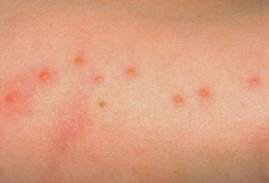 ploșnițe Bites asupra simptomelor persoanei, tratament (persoană) Bites ploșnițe asupra simptomelor persoanei, tratamentul