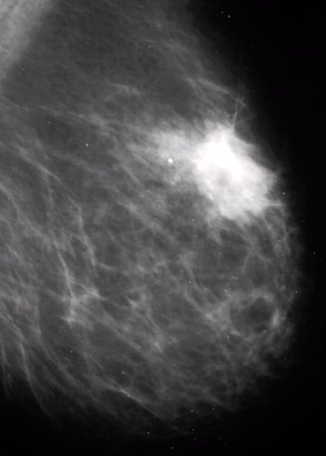 Diagnostic cu ultrasunete de mastopatie nodulare - Menshakova e (nod) Diagnostic cu ultrasunete de mastopatie nodulare - Menshakova e