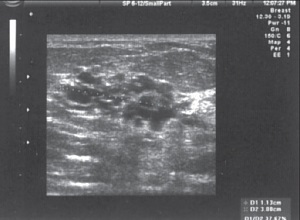 Diagnostic cu ultrasunete de mastopatie nodulare - Menshakova e (mastopatie nodală) Diagnostic cu ultrasunete de mastopatie nodulare - Menshakova e